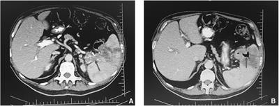 Splenocolic fistula in a patient with diffuse large B-cell lymphoma: A case report and review of literature